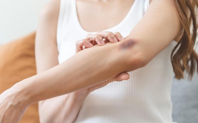 Đằng sau những vết bầm tím không rõ lý do 