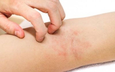 Chăm sóc trẻ bị viêm da cơ địa sao cho đúng?