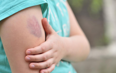 6 dấu hiệu cảnh báo nhiễm trùng máu 