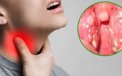 Khi bị viêm họng nên kiêng ăn gì?