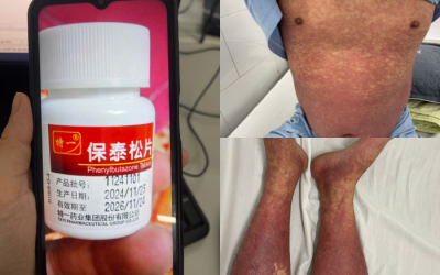 Người bệnh xương khớp cần cảnh giác với thuốc chống viêm Phenylbutazone