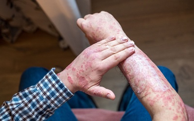 Vảy nến toàn thân khó chữa ra sao?