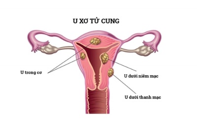 U xơ tử cung dưới thanh mạc là gì?
