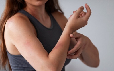 Mẹo xử lý phát ban da do quần áo ẩm ướt