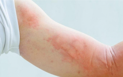 “Điểm danh” các loại ký sinh trùng có thể xuất hiện trên cơ thể người