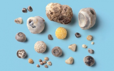 Có nhiều viên sỏi mật 9 - 11mm dùng TPBVSK Kim Đởm Khang được không?