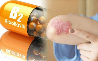 Lợi ích của vitamin B2 với người bệnh vảy nến