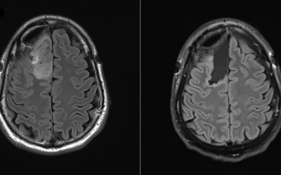 Australia: Thử nghiệm lâm sàng đầu tiên thuốc mới điều trị u não
