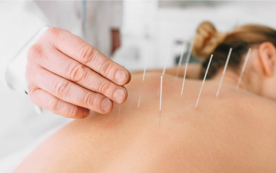 Châm cứu giảm đau: Cách thức hoạt động và những điều cần lưu ý
