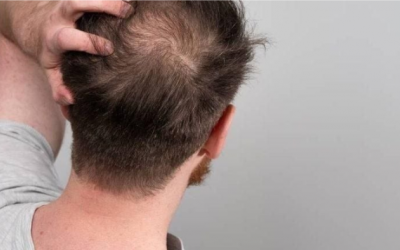 Đồ uống có đường làm tăng nguy cơ rụng tóc?