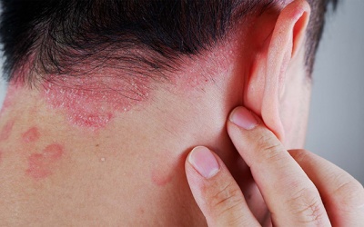 Làm sao để kiểm soát vảy nến mà không lệ thuộc thuốc?