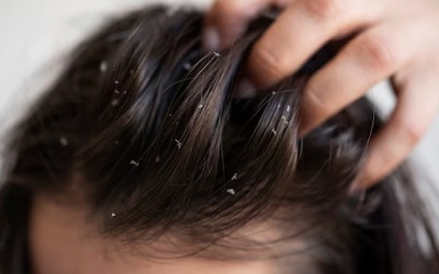 Bí quyết đánh bay gàu hiệu quả