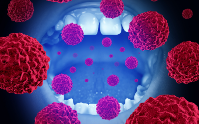 7 thực phẩm giúp giảm nguy cơ ung thư khoang miệng