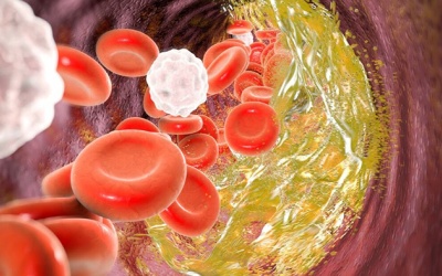 Biến chứng nguy hiểm khi mắc tăng mỡ máu hỗn hợp 