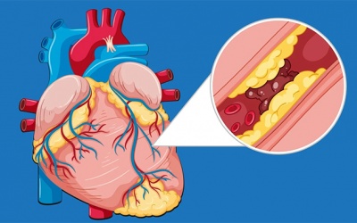 Động mạch vành bị hẹp 30 - 50%: Có cần đặt stent không?