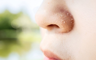 Mẹo hay giải cứu cho vùng da khô quanh mũi