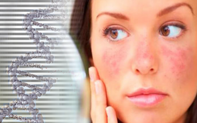 Yếu tố di truyền có ảnh hưởng đến bệnh lupus ban đỏ không?