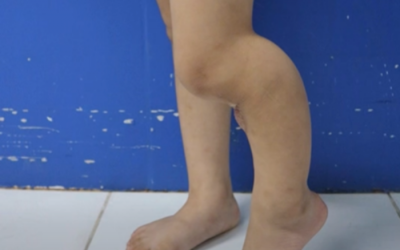 Có nên chữa gãy xương, viêm xương cho trẻ bằng cách đắp lá?	