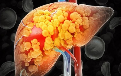 3 yếu tố chính gây bệnh gan nguy hiểm