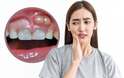 Bị viêm lợi có mủ liệu có tự khỏi được không?