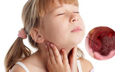 Biến chứng viêm amidan quá phát độ 4 ở trẻ em - Cha mẹ chớ chủ quan