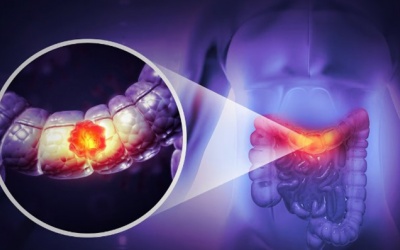 Cẩn thận với 5 dấu hiệu cảnh báo ung thư đại trực tràng