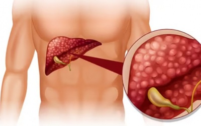 Cảnh báo 5 thói quen gây sỏi mật