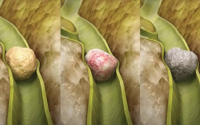 Bạn cần biết gì về sỏi ống túi mật?