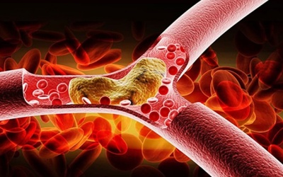 Mỡ máu cao: Sát thủ thầm lặng của hệ tim mạch
