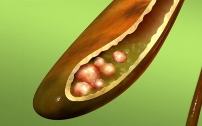 Có sỏi bùn túi mật nên uống gì để cải thiện?