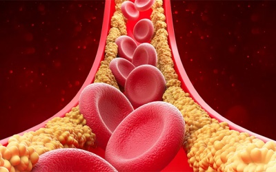 Cholesterol cao - 'thủ phạm' âm thầm bào mòn động mạch vành