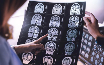 WHO: Cần quan tâm đúng mức đến các bệnh lý thần kinh