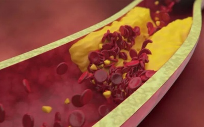 Thiếu máu cơ tim do hẹp mạch vành 55% xử trí thế nào?