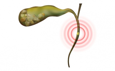 Có sỏi ống mật chủ 22mm cần xử trí thế nào?