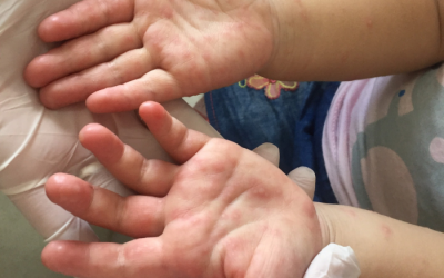 Chăm sóc trẻ bị tay chân miệng tại nhà đúng cách 