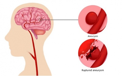 Dấu hiệu tiềm ẩn cảnh báo bệnh phình động mạch não 