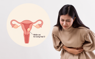 Cách kiểm soát nhân xơ tử cung loại 2 để tránh biến chứng