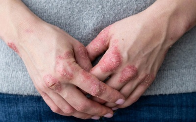 Giải pháp cho người vảy nến đang điều trị bệnh dạ dày