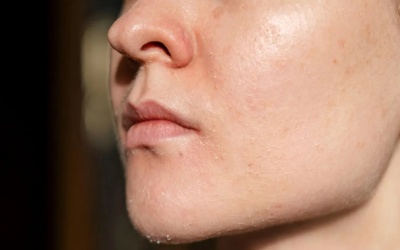 Cần làm gì khi da mặt bị bong tróc vào trời lạnh?