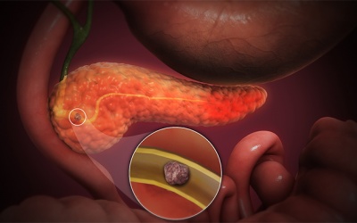 Có sỏi ống tụy 12mm cần xử trí thế nào để kiểm soát bệnh?