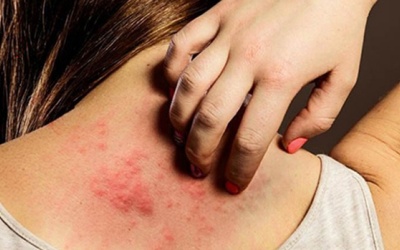 Vì sao bệnh vảy nến trở nặng khi trời lạnh?