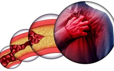 Mỡ máu cao - “thủ phạm” gây đột quỵ, nhồi máu cơ tim