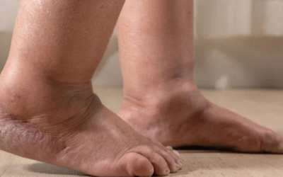 Sưng tấy bàn chân kéo dài cảnh báo dấu hiệu bệnh lý gì?