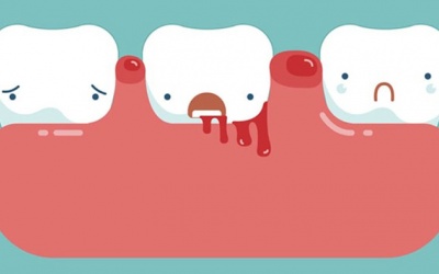 Cách cải thiện tình trạng chảy máu chân răng