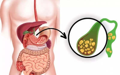 Sỏi túi mật 7,5mm có nguy hiểm không?