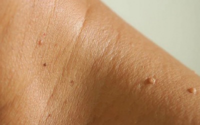 5 dấu hiệu cảnh báo bệnh đái tháo đường bạn không nên bỏ qua