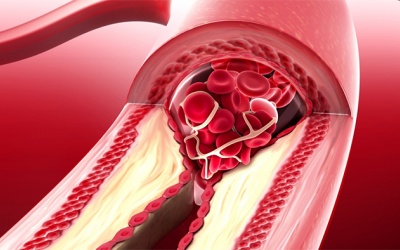 Hẹp mạch vành do vôi hóa khác gì do mảng bám cholesterol?