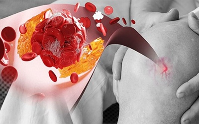 Yoga có giúp kiểm soát acid uric cao không?