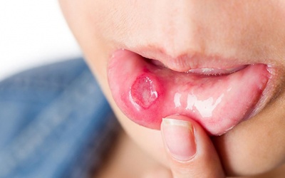 Dấu hiệu ở miệng chứng tỏ bạn thiếu vitamin B12