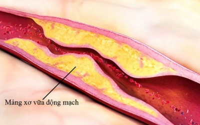 Yếu tố nguy cơ gây xơ vữa động mạch nên biết để phòng ngừa